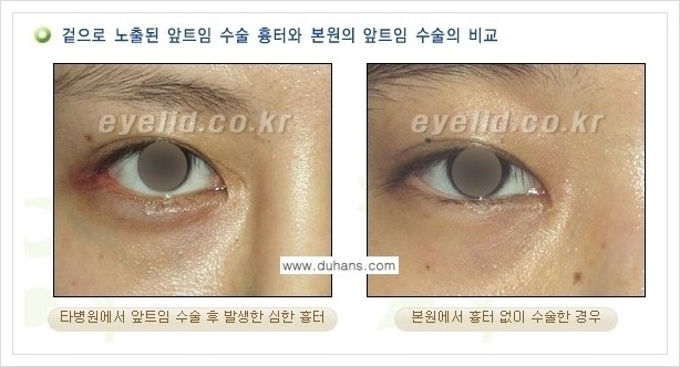 [두한성형외과 경쟁력 눈성형] - [몽고주름 제거수술, 앞트임 수술 안내] 관련 이미지 3