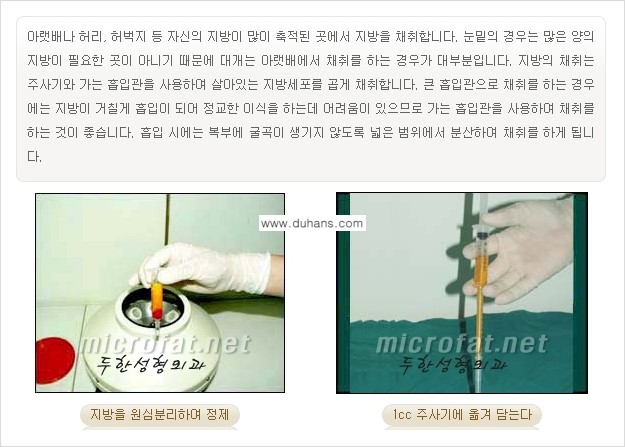 [두한성형외과의 경쟁력 있는 지방이식] - [눈밑 애교살 미세지방이식 1.] 관련 이미지 5