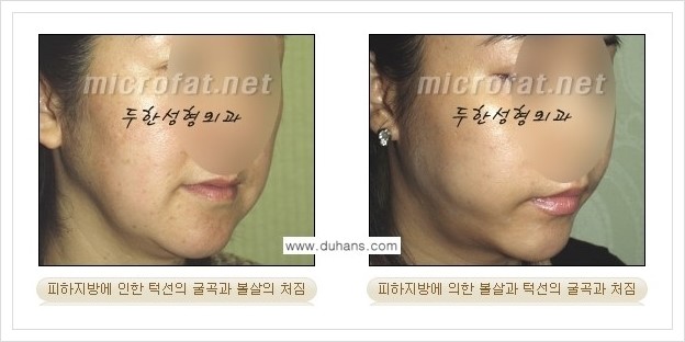 [두한성형외과 경쟁력 얼굴지방흡입] - [통통한 볼살, 두툼한 턱살(턱선)의 지방흡입] 관련 이미지 2