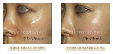 [Facial Autologous Fat Grafting, Duhan Plastic Surgery] - [Indian Wrinkle] image 14