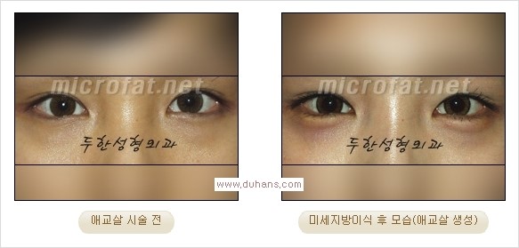 [두한성형외과 경쟁력 눈밑성형] - [타 병원 필러 애교살 시술 부작용을 미세지방이식으로 교정] 관련 이미지 22