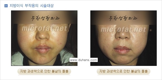 [두한성형외과 경쟁력 미세지방이식] - [타병원에서의 미세지방이식 이후 부작용 교정의 대상 안내] 관련 이미지 1