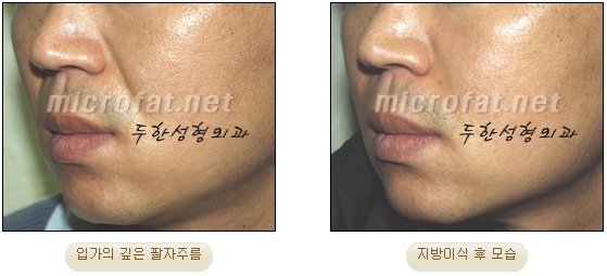 Wrinkle Improvement, Duhan Plastic Surgery - Mouth Lines, Nasolabial Folds image 16