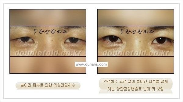 [두한성형외과 경쟁력 쌍꺼풀 재수술(극한 재수술)] - [안검하수(졸리운 눈매) 교정 안내 1.] 관련 이미지 15