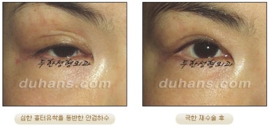 [Special Double Eyelid Revision Surgery at Duhan Plastic Surgery] - [Restorative Surgery for Damaged Double Eyelid Eye Shape] image 18
