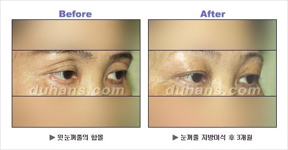 [두한성형외과 경쟁력 안검성형] - [상큼하고 환한 눈매의 완성 상안검 성형술 안내] 관련 이미지 8