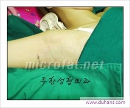 [두한성형외과 경쟁력 액취증 치료] - [참기 힘든 겨드랑이 냄새 액취증, 암내 치료] 관련 이미지 9