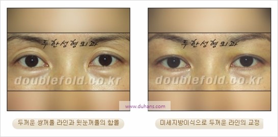 [두한성형외과 경쟁력 눈성형] - [쌍꺼풀 재수술에 대한 최선의 대안 제시] 관련 이미지 20