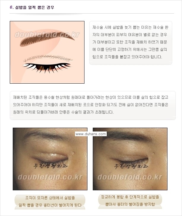 [두한성형외과 경쟁력 쌍꺼풀 재수술(눈재수술)] - [쌍꺼풀 재수술(눈재수술)의 실패의 원인 분석] 관련 이미지 7