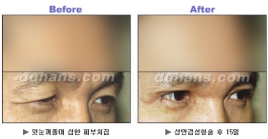 Blepharoplasty, Duhan Plastic Surgery - Upper and Lower Eyelids image 13