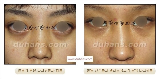 [두한성형외과 경쟁력 안검성형] - [젊은 눈매 안검성형의 여러 가지 방법 안내] 관련 이미지 52