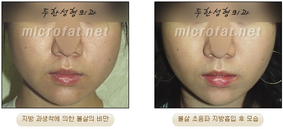 [Duhan Plastic Surgery Liposuction] - [Facial Liposuction] image 27