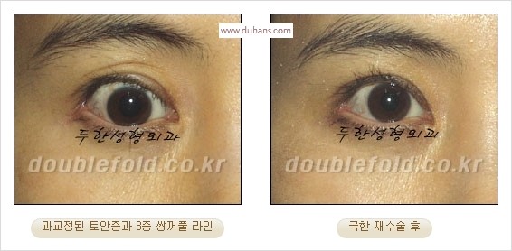 [두한성형외과 경쟁력 쌍꺼풀 재수술 스페셜] - [망가진 라인을 교정하는 극한 재수술] 관련 이미지 17