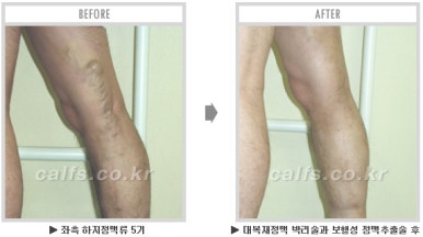 [종아리 두한성형외과] - [나에게 맞는 종아리시술] 관련 이미지 67