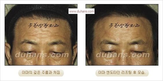 [두한성형외과 경쟁력 주름성형] - [간단하고 부작용 없는 자연스러운 주름제거 방법] 관련 이미지 14