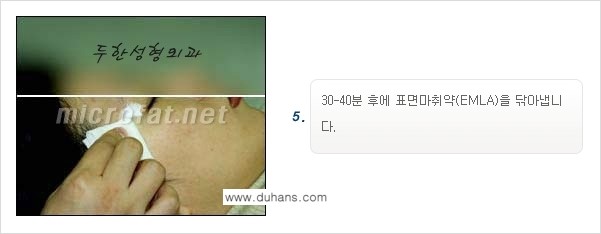 [두한성형외과 경쟁력 퀵성형] - [필러주사(쥬비덤)으로  간단하고 빠르게 주름교정] 관련 이미지 12