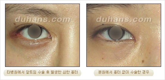 [DuHan Plastic Surgery Eye Surgery] - [Guide to Epicanthoplasty and Canthoplasty for Increasing the Horizontal Width of the Eyes] image 10