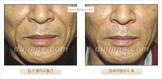 [두한성형외과 경쟁력 주름성형] - [간단하고 부작용 없는 자연스러운 주름제거 방법] 관련 이미지 25