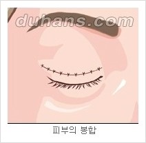 [두한성형외과 경쟁력 눈성형] - [젊은 눈매로의 복원 안검성형] 관련 이미지 6
