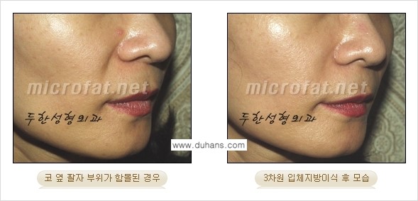 [두한성형외과의 경쟁력 미세지방이식] - [귀족수술과 인디언밴드 미세지방이식 안내 ③] 관련 이미지 7