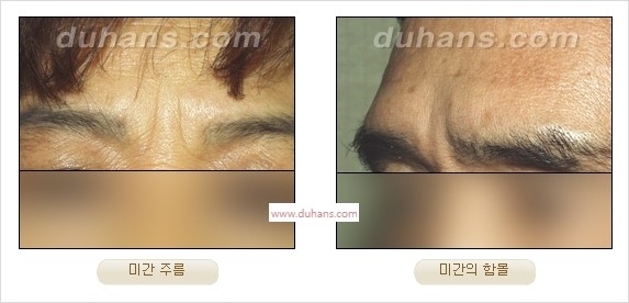 [두한성형외과 경쟁력 주름성형] - [주름제거를 위한 리프팅] 관련 이미지 6