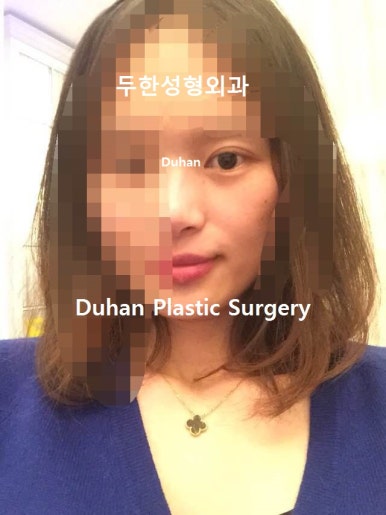 [두한성형외과 쌍커풀수술] - [쌍꺼풀지방이식] 관련 이미지 66