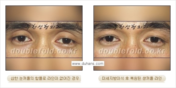 [두한성형외과 경쟁력 눈성형] - [미세지방이식으로 풀린 라인의 교정 방법 안내] 관련 이미지 3