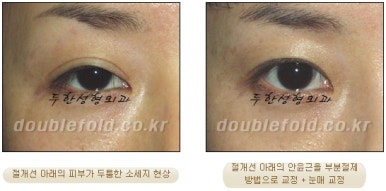 [두한성형외과 쌍커풀재수술] - [심한 소세지눈, 두줄따기, 쌍꺼풀 흉터] 관련 이미지 35
