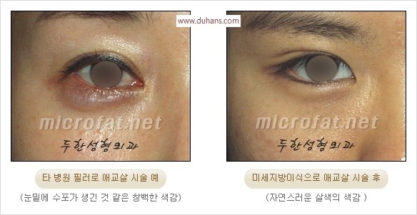 [두한성형외과 경쟁력 눈밑성형] - [타 병원 필러 애교살 시술 부작용을 미세지방이식으로 교정] 관련 이미지 4