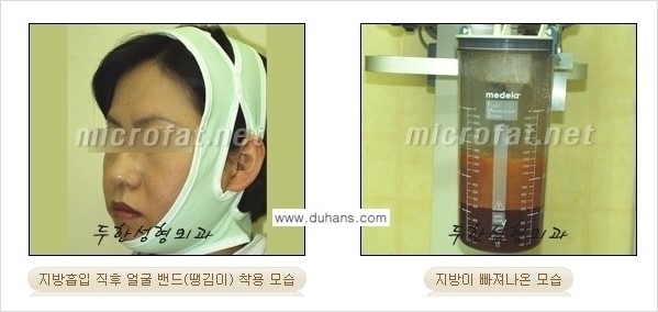 [두한성형외과 경쟁력 지방흡입] - [얼굴, 볼살, 턱살, 턱선의 초음파 지방흡입] 관련 이미지 10