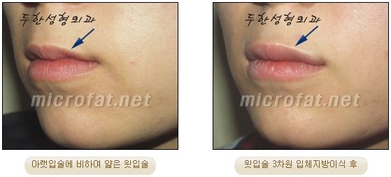 [Duhan Plastic Surgery Lip Surgery] - [Lip Correction Fat Grafting] image 21