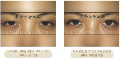 두한성형외과 눈재수술 - 쌍꺼풀 재수술 방법 관련 이미지 9