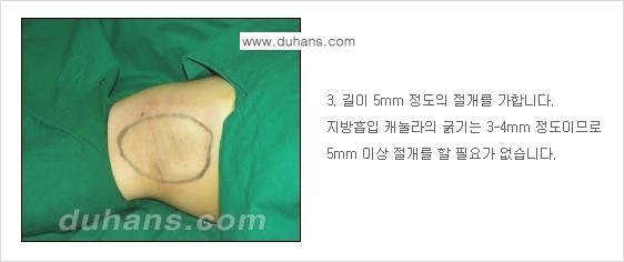 [두한성형외과 성형 FOCUS 지방흡입] - [액취증 - 다한증 초음파 컷터 지방흡입 ④] 관련 이미지 4