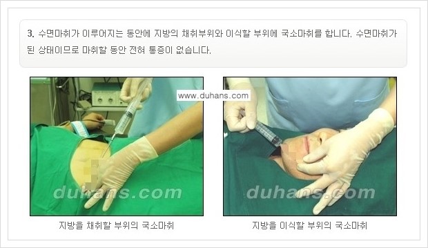[두한성형외과 경쟁력 미세지방이식] - [부드럽고 아름다운 얼굴선 만들기, 얼굴 미세지방이식 과정 안내] 관련 이미지 2