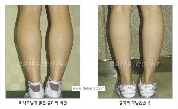 [두한성형외과 경쟁력 종아리성형] - [종아리 지방흡입 2.] 관련 이미지 9