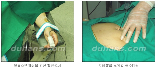 [Duhan Plastic Surgery Simple Liposuction] - [Liposuction for Obesity] image 7