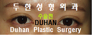 [Eye Surgery, Duhan Plastic Surgery] - [Revision Surgery for a Thick Double-Eyelid Line] image 21