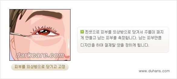 [두한성형외과 경쟁력 다크써클 교정] - [젊어 보이면서 개선된 인상을 주는 하안검 성형술] 관련 이미지 7