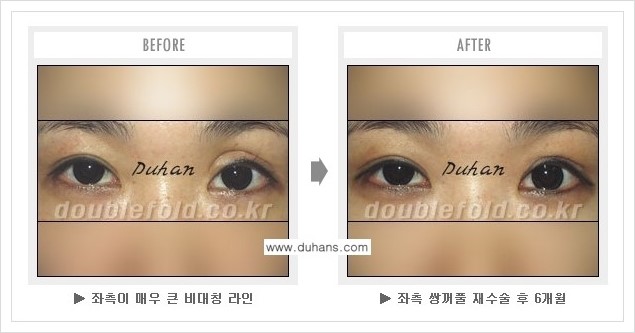 [두한성형외과 경쟁력 쌍꺼풀 재수술(극한 재수술)] - [피부 여유분이 부족해서 토안증이 발생한 경우의 문제점 해결 안내] 관련 이미지 3