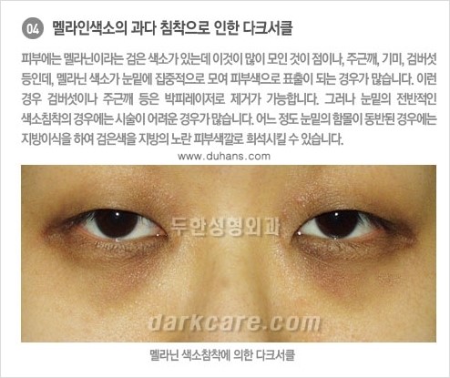 [두한성형외과 NO.1 경쟁력] - [원인과 색에 따른 다크써클의 종류] 관련 이미지 5