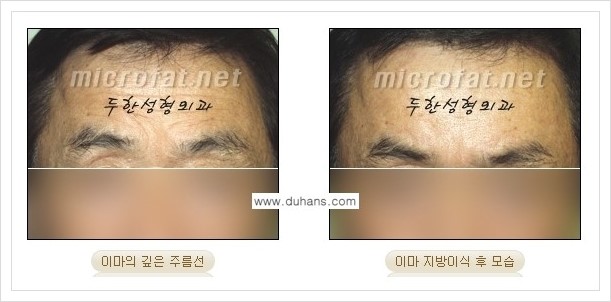 [두한성형외과 경쟁력 미세지방이식] - [부드럽고 아름다운 얼굴 윤곽선 이마(전두부) 미세지방이식] 관련 이미지 10