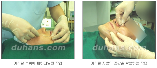 [두한성형외과 얼굴자가지방이식] - [지방이식 과정] 관련 이미지 16