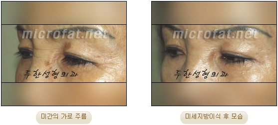 [두한성형외과 자가지방이식] - [미간주름] 관련 이미지 9
