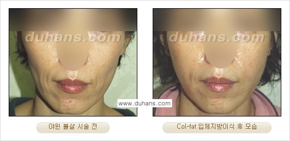[두한성형외과 경쟁력 미세지방이식] - [탄력있는 피부와 윤곽을 만들어주는 Col-fat 지방이식] 관련 이미지 17