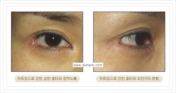 [두한성형외과 경쟁력 쌍꺼풀 재수술, 극한 재수술] - [뒤트임 수술에 대한 안내] 관련 이미지 2