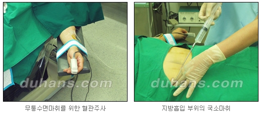 [Duhan Plastic Surgery Simple Liposuction] - [Liposuction for Obesity] image 3