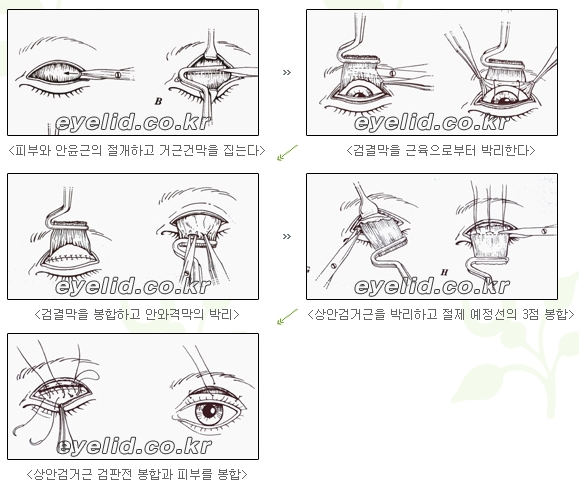 [Duhan Plastic Surgery Secondary Double Eyelid Surgery] - [Sleepy Eye Appearance, Asymmetrical Eye Appearance, Ptosis] image 9
