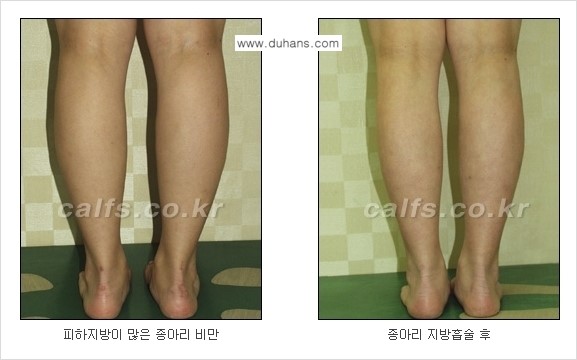 [두한성형외과 매력적인 종아리 만들기!] - [정교한 미세흡입관 지방흡입술 2.] 관련 이미지 9