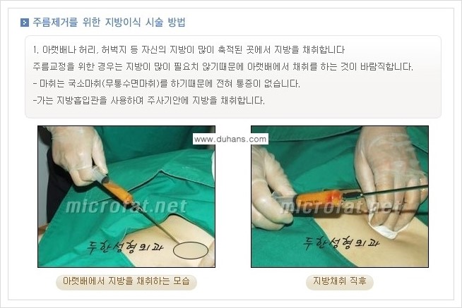 [두한성형외과 경쟁력 지방이식] - [입가주름, 팔자주름 미세지방이식의 안내] 관련 이미지 3