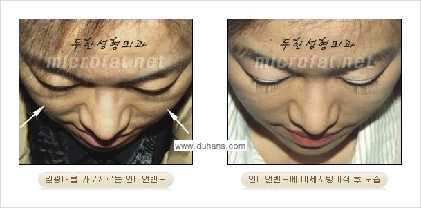 [두한성형외과 경쟁력 미세지방이식] - [귀족수술과 인디언밴드(앞광대주름) 미세지방이식] 관련 이미지 21